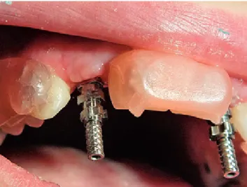 Fig. 6. View of the impression with the transfer screws protruded through  the tray