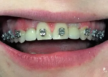 Fig. 11. View of the final screw retained crowns in position 12 and 22 –  without the orthodontic wire