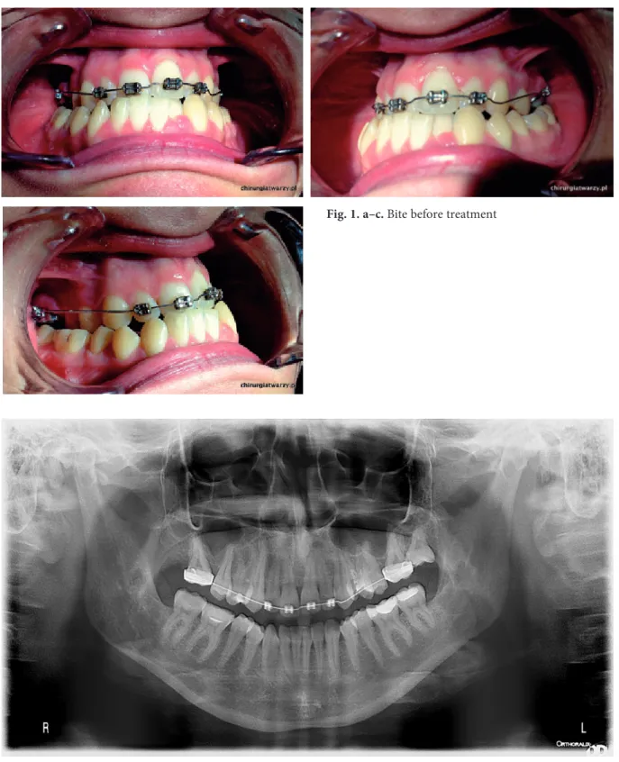 Fig. 2. Panoramic x-ray before treatment