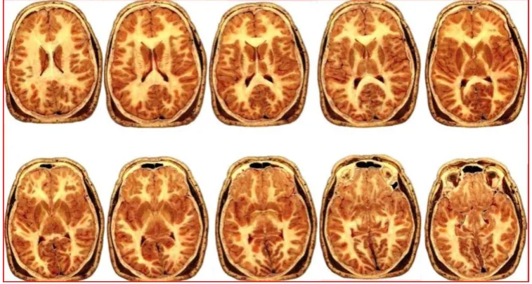 Figure 3 (left) and 4 (right): Both figures show the digital sagittal slice 'parent' images of the head, arbitrarily labeled 'A' (Figure 3) and 'B' (Figure 4)