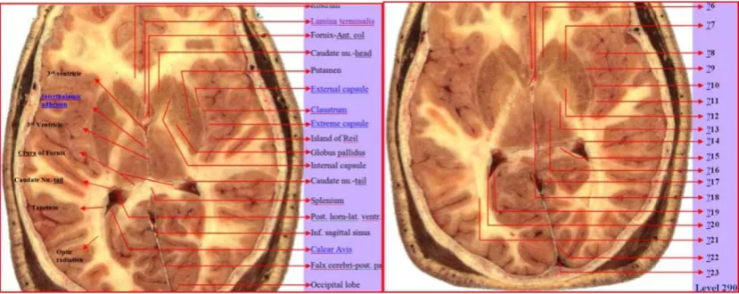 Figure 6 (left) and 7 (right): These figures represent two sample transverse ‘child' images of the head at 120 mm and 140 mm from scalp surface