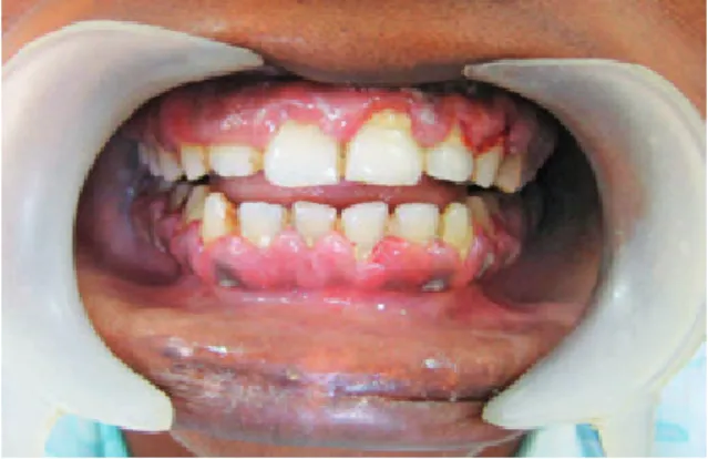 Fig. 4. Gingival enlargement on palatal aspect of maxil- maxil-lary teeth