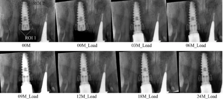 Fig. 2. Series of analyzed radiographs with marked ROI1 [marginal crestal bone] and ROI2 [reference periapical bone]