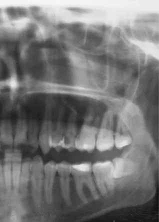 Fig. 1. Panoramic radiography. Clinical case no. 1. 