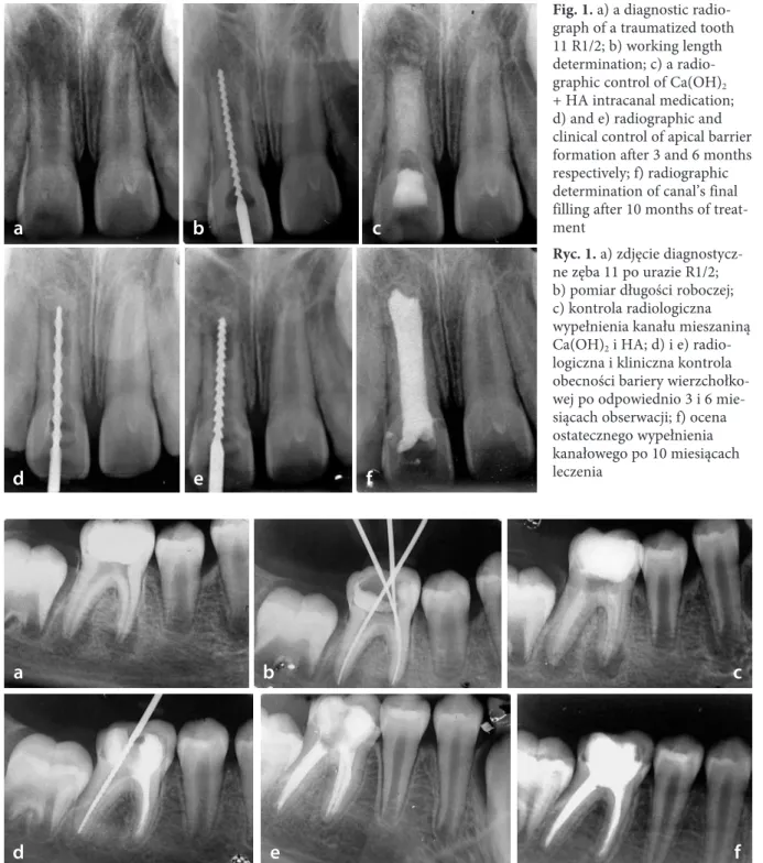 Fig. 1. a) a diagnostic radio- radio-graph of a traumatized tooth  11 R1/2; b) working length  determination; c) a  radio-graphic control of Ca(OH) 2 