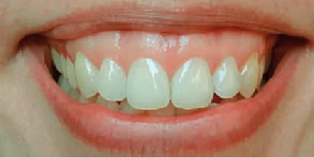 Fig. 2. Gingival smile – VME – vertical maxillary  excess (from the collection of the individual dental  practice R