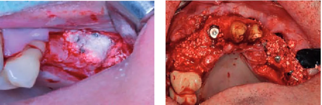 Fig. 1. Jaw bone augmentation – surgical procedure graft consist of: BTCp + allogenic bone granules (up), xenogenic  mineral + allogenic bone granules