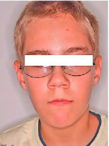 Fig. 2. Self-induced cutaneous lesions caused by com- com-pulsive picking