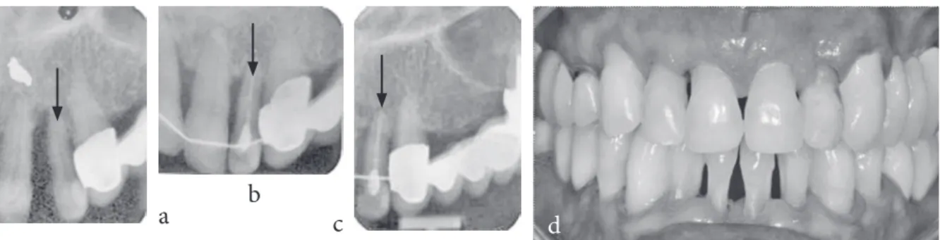 Fig. 4. a) intraoral radiograph before the orthodontic treatment – minimal bone support at the left upper lateral  incisor