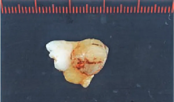 Fig. 1. Macroscopic view of the tooth derived from the  lumen of the left maxillary sinus