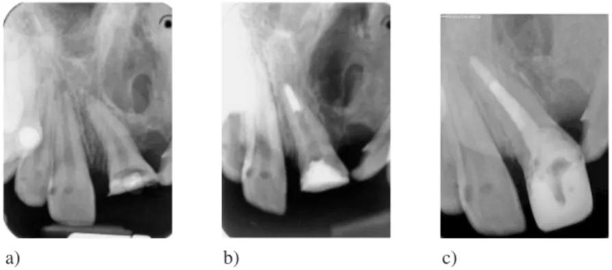 Fig. 2A) Patient Ś.A. Tooth 21 – first noticeable mineralised barrier in apical region control x−ray before treatment;