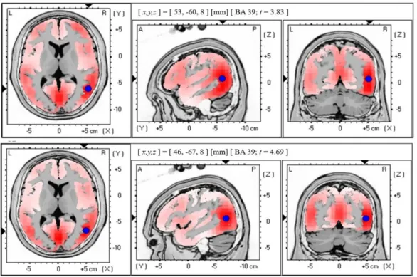 Figure 1. Graphical representation of the standardized Low-resolution Electromagnetic Tomography (sLORETA)   t-statistic comparing the mean MMN deviant stimuli responses at the epoch of 50-ms time window between 215-284 ms  of the global field power (GFP) 