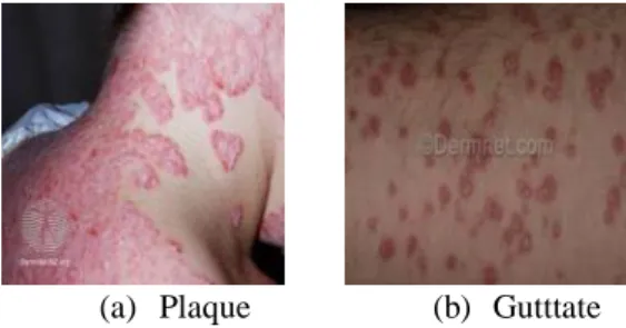 Figure 2 shows a sample of Plaque and Guttate Psoriasis skin disease. 