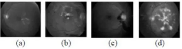 Figure 2 (a-d). Original DR affected Eye Image 