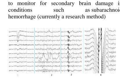 Figure 1.3. Human EEG artifacts 