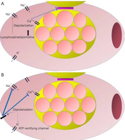 Figure 1 Cellular changes occurring in response to ischemia. (A) Initially, ischemia induces influx of calcium from the sarcolemma to the  cytosol and sodium influx from the extracellular space, resulting in cell depolarization