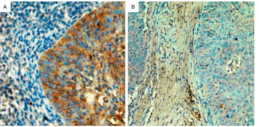 Figure 1. Localization of ROCK1 via immunohistochemistry. The positive (A) and negative (B) staining of ROCK1 in LSCC tissues (200 ×).
