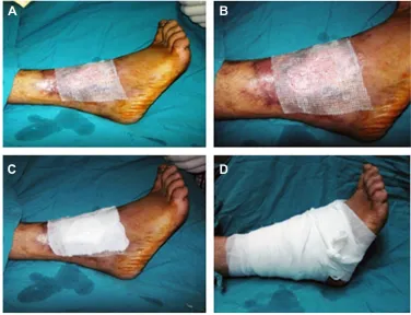 Figure 2 amniotic membrane application over two leg ulcers.Notes: Two leg ulcers in one patient (A); application of amniotic membrane over the leg ulcers (B and C); image of the patient after amniotic membrane grafting (D).
