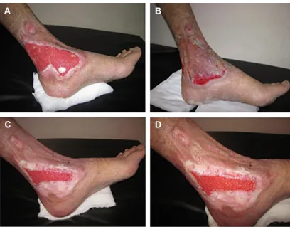 Figure 4 Healing of two leg ulcers after amniotic membrane application.Notes: Two leg ulcers in one patient (A); application of amniotic membrane on the two ulcers (B); reduction in size of both ulcers (C); complete healing of the upper ulcer and 70% reduction in the size of the lower one on follow up (D).
