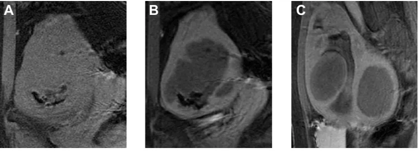 Figure 2 Examples of MRgFUS screen failures.Notes: (A) Sagittal T1-weighted image (T1WI) prior to contrast demonstrates area of very low signal along the inferior margin of the fibroid