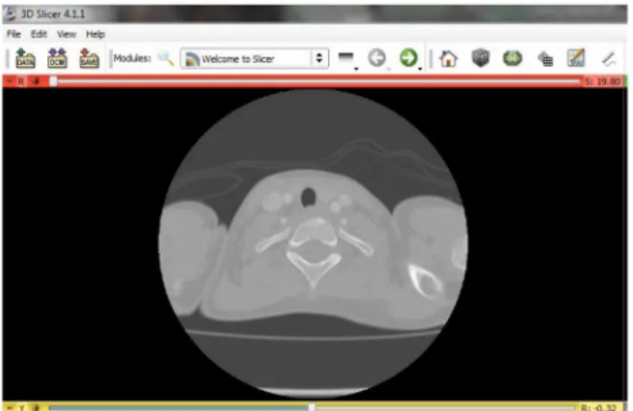 Figure 1. CTA images with 3D slicer.