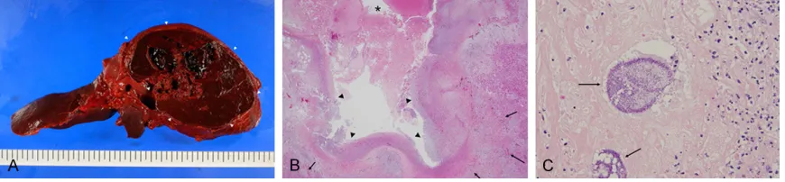 Figure 2. A. Gross appearance of the liver obtained from the autopsy in Case 12. Cut surface revealed pseudocystic and partially necrotic lesion of 8 cm in the maximum dimension (arrow heads)
