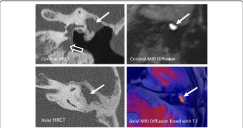 Fig. 18 Comparison of postoperative HRCT and CBCT in a 53-year-old female patient. Axial (left images) and paracoronal (right images) images.HRCT images show more metal artifacts (arrows) and blooming artifacts than CBCT images