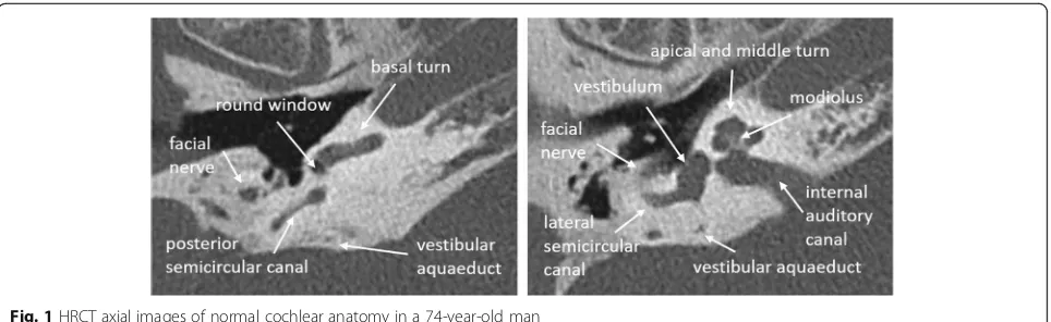 Fig. 3 MRI 3D-CISS axial images of normal cochlear anatomy in a 40-year-old woman