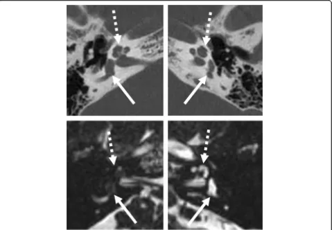 Fig. 16 A 70-year-old male patient, with progressive SNHL from advanced otosclerosis. HRCT axial (left image) and paracoronal (right image)image show irregular ossifications affecting the cochlea (black arrows)
