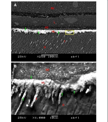 Figure 3 Backscattered images of the SB2/FL group. In (A) (250×) silver deposition (green narrows) wasobserved in the entire thickness of the Hybrid Layer (HL) and in parts of the adhesive layer