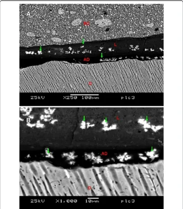 Figure 5 Backscattered images of the CS3/PL group. In (A) (250×) water tree (green narrows) wasobserved in the Adhesive Layer (AD) and silver depositions in the Liner layer (L)