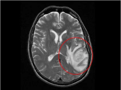 Figure 1.1: MRI image showing tentacle-like extensions of a GBM tumor located in the right hemisphere (Courtesy of Medscape)