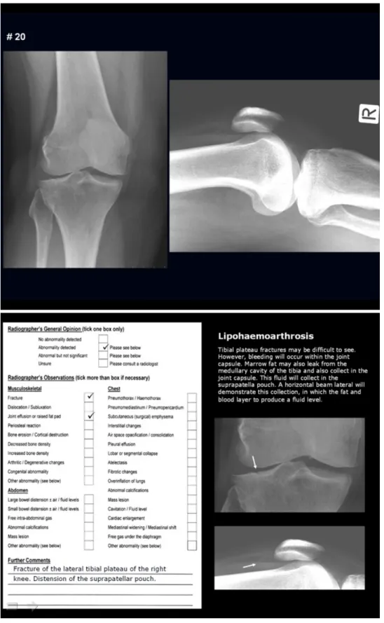 Figure 1:  An example of the Microsoft PowerPoint directed learning, self-test image interpretation quizzes (top) with  model answers using the radiographer opinion form (ROF) format
