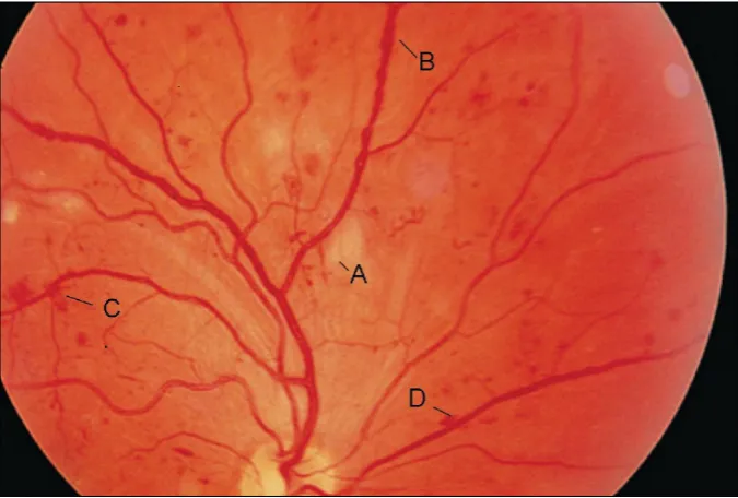 Figure 1. Fundus photo of the right eye demonstrating the severe nonproliferative stage of diabetic retinopathy including A) cotton-wool spot; B) venous beading; C) intraretinal microvascular abnormalities; and D) intraretinal hemorrhages.