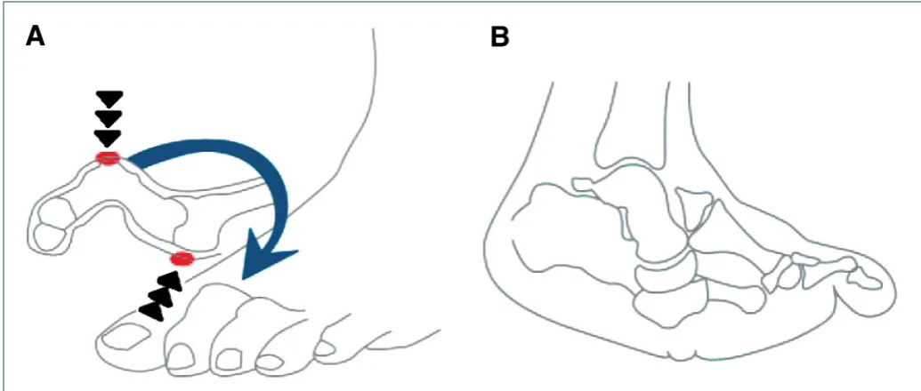 Figure 1. Common foot deformities resulting from diabetes complications: A) claw toe deformity (increased pressure is placed on the dorsal and plantar aspects of the deformity as indicated by the triple arrows); and B) Charcot arthropathy (the rocker-botto