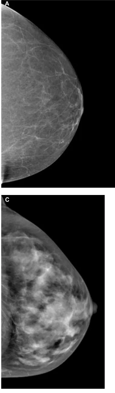 Figure 1 The four breast parenchymal patterns.Notes: (A) Fatty; (B) scattered; (C) heterogeneously dense; (D) extremely dense.