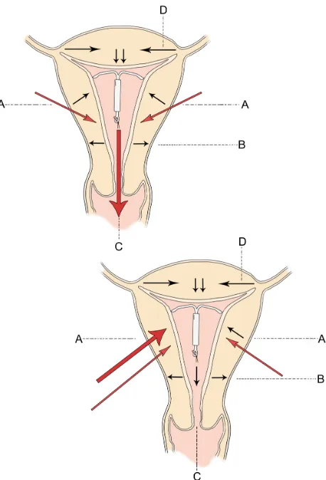 Figure 2 Direction of uterine forces in the normal intrauterine device containing uterus are given at (A–D) in the top diagram