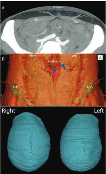 Fig 1. CTA-based 3D perforator mapping in DIEP flap planning performed  using OsiriX software
