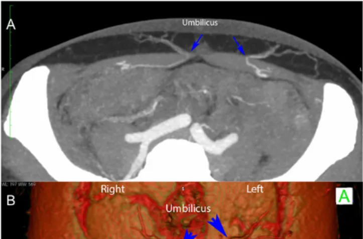 Fig 1. Case 1. High resolution ultrasonography visualizing bifid median  nerve (circled structures A and B on left image, C and D on right image)