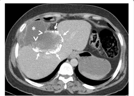 Fig. 3 A 62-year-old woman presented to the emergencydepartment with fever, fatigue, and right upper quadrant pain