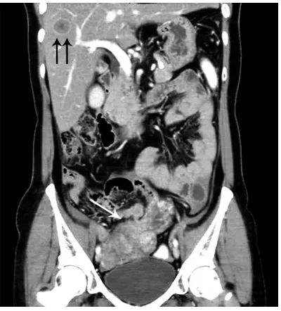 Figure 1. CT findings. CT image (coronal plane) of large pelvic mass (single arrow), and liver lesions (double arrow)