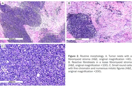 Figure 2. Routine morphology. A. Tumor nests with a fibromyxoid stroma (H&E, original magnification ×40)