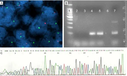 Figure 4. Results of the molecular genetic study. A. Neoplastic cells demonstrating break-apart/rearrangement (FISH for EWSR1 gene rearrangement)