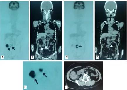 Figure 1. PET/CT images show hypermetabolic foci of a 5 cm mass and several swelling of mesenteric lymph nodes, compatible with a bowel obstruction.