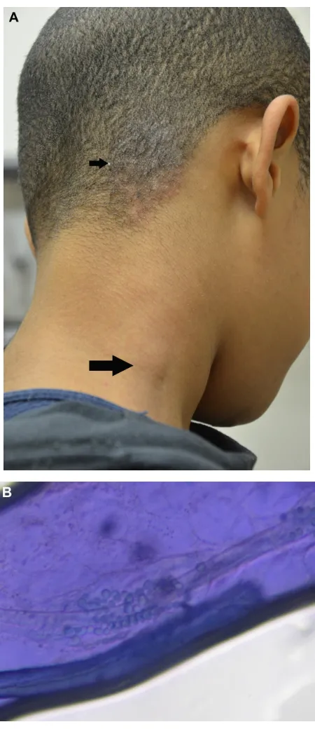 Figure 5 Tinea capitis.Notes: (A) Scaly plaque with broken hairs and mild bogginess on the posterior right scalp (small arrow)