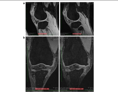 Fig. 1 Sample images show magnetic resonance imaging (MRI)-detected osteophyte (OP) progression.baseline to follow up (wider arrow indicates follow-up MRI-detected OP)