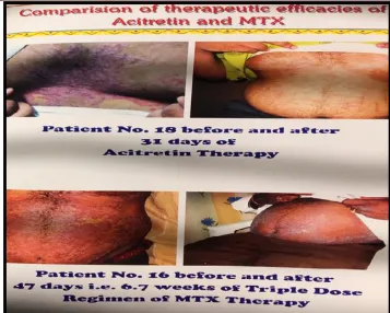 Fig. 1: Comparison of therapeutic efficacies of Acitretin and MTX 