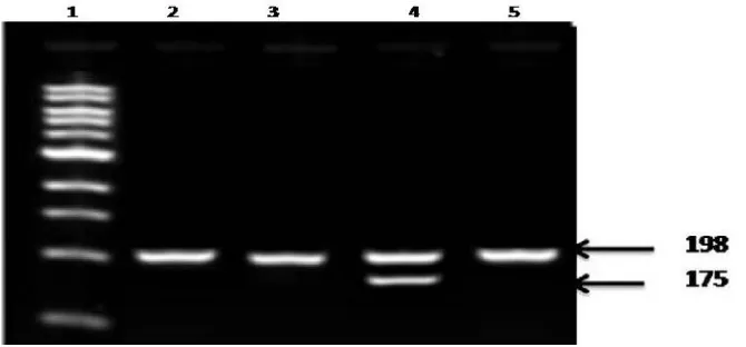 Fig. 1. MTHFR PCR products after restriction digestion with Hinf1 on 3% agarose gelLane 1 = 100bp DNA Ladder, Lane 2,3,5 = CC genotypes, Lane 4 = CT genotypes