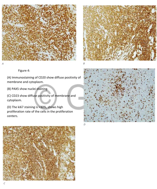 Figure 4:  (A) Immunostaining of CD20 show diffuse positivity of 