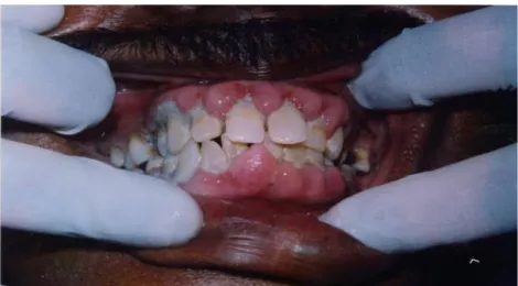 Fig. 5a: Case 5: Severe generalized fibrous and lobulated gingival enlargement 